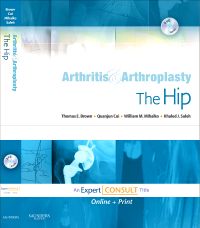 Arthritis and Arthroplasty: The Hip